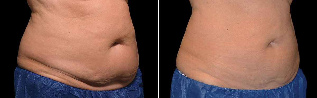 Coolsculpting Vorher Nachher Foto